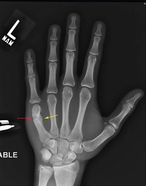 physical therapy for boxer's fracture